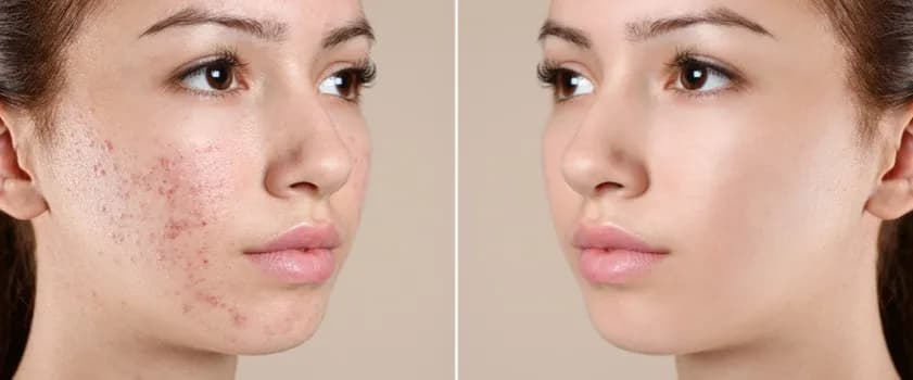 Jak skutecznie zmniejszyć tłustą cerę i cieszyć się zdrową skórą