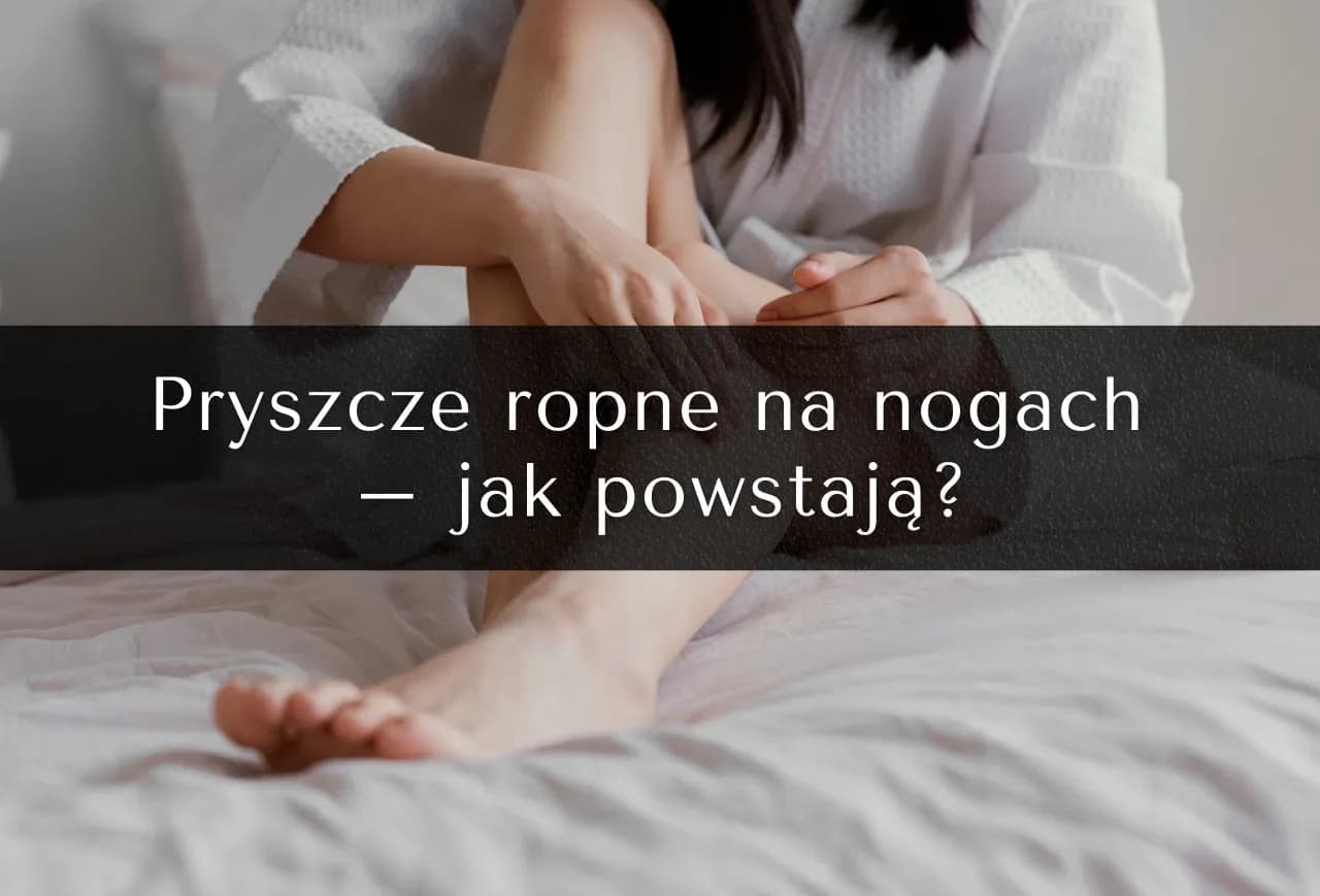 Pryszcze na nogach od czego: Poznaj przyczyny i skuteczne rozwiązania