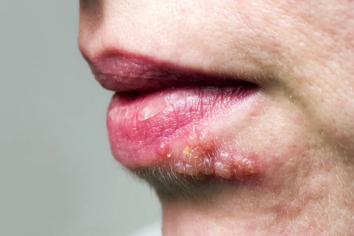 Opryszczka czy pryszcz: jak je odróżnić i skutecznie leczyć