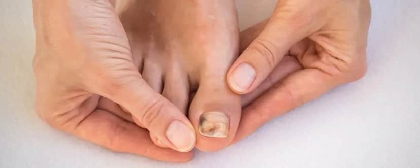 Czy czerniak paznokcia boli? Dowiedz się, co warto wiedzieć o objawach