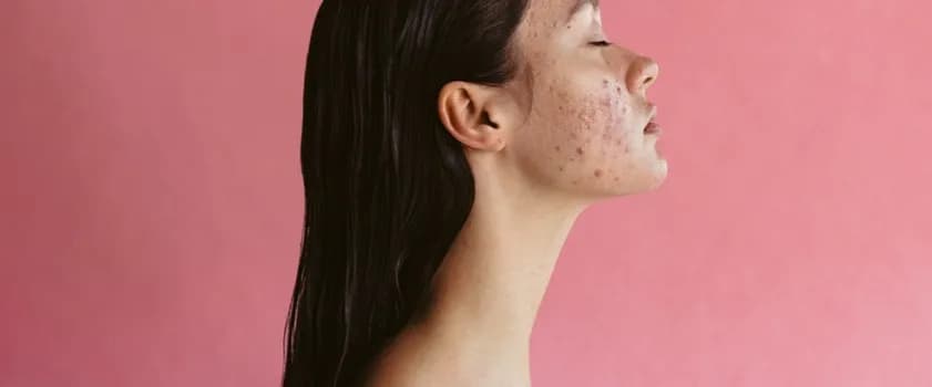 Co na wycisniete pryszcze? Skuteczne sposoby na szybkie gojenie