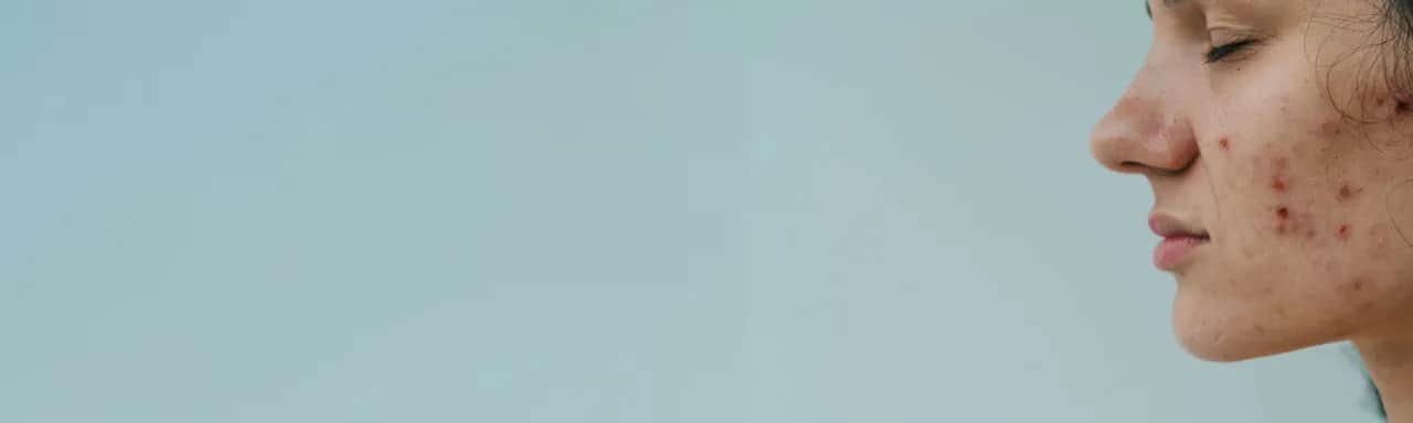 Skąd się biorą pryszcze? Odkryj przyczyny i jak ich uniknąć
