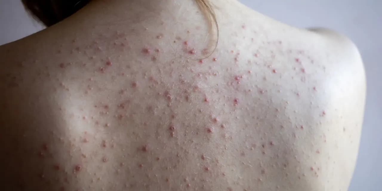 Skuteczne sposoby na pryszcze na plecach - pozbądź się problemu raz na zawsze