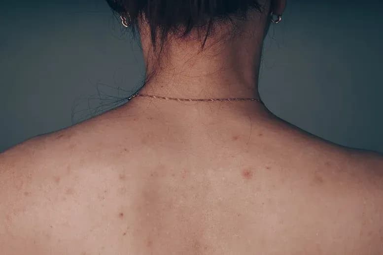 Skuteczne sposoby na pozbycie się pryszczy na plecach raz na zawsze