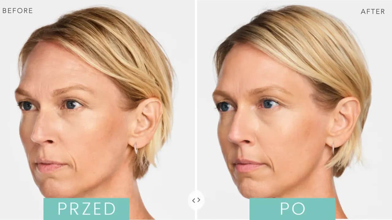 Radiesse czy kwas hialuronowy - porównanie skuteczności i zastosowania