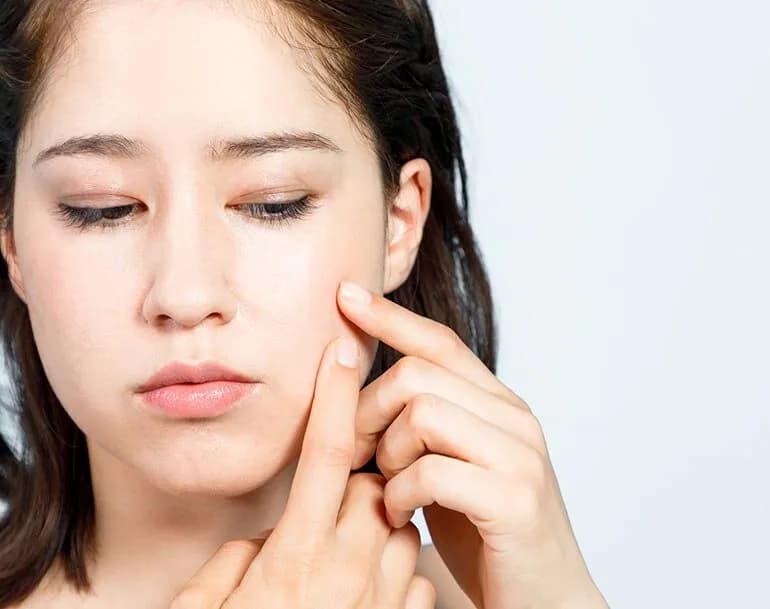 Czy pryszcze same znikają? Poznaj prawdę o ich leczeniu i gojeniu