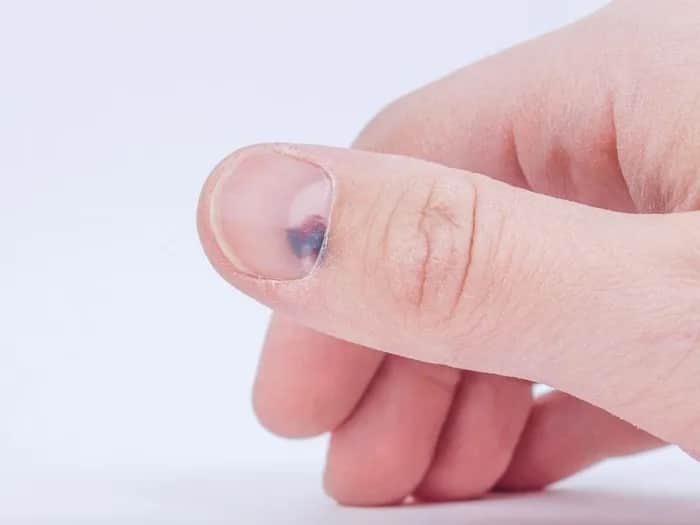 Jak wygląda czerniak paznokcia zdjęcia – rozpoznaj objawy na czas