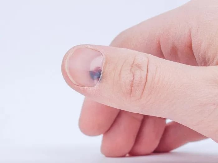 Jak wygląda czerniak paznokcia zdjęcia – rozpoznaj objawy na czas