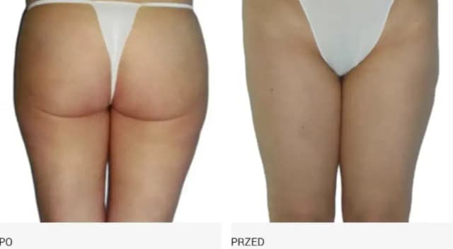 Jak często robić endermologię, aby uniknąć rozczarowania efektami?