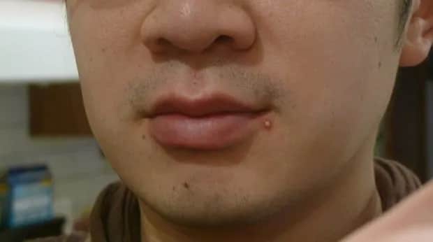 Dlaczego wyciskanie pryszczy jest przyjemne? Poznaj psychologię tej czynności