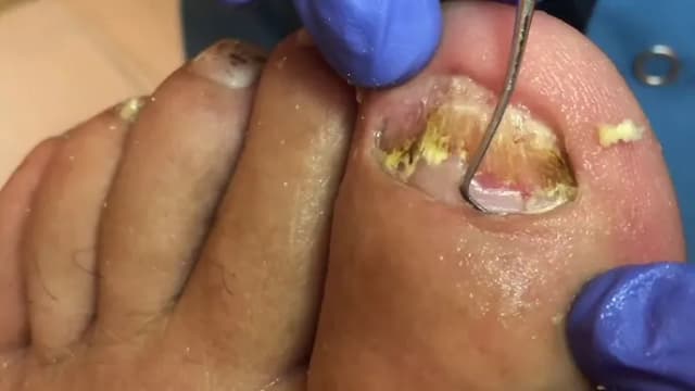 Jak obcinać paznokcie u nóg na YouTube, aby uniknąć błędów