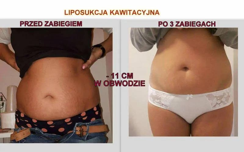 Co lepsze: lipolaser czy liposukcja kawitacyjna? Porównanie skuteczności