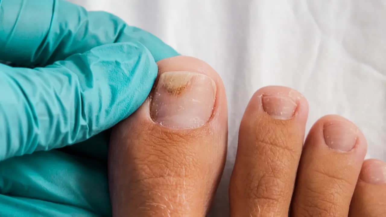 Jak leczyć zrogowaciałe paznokcie u nóg - skuteczne metody i porady