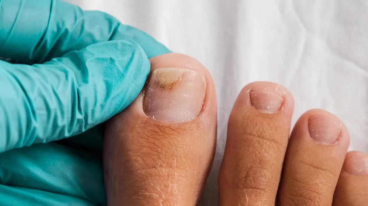 Jak leczyć zrogowaciałe paznokcie u nóg - skuteczne metody i porady