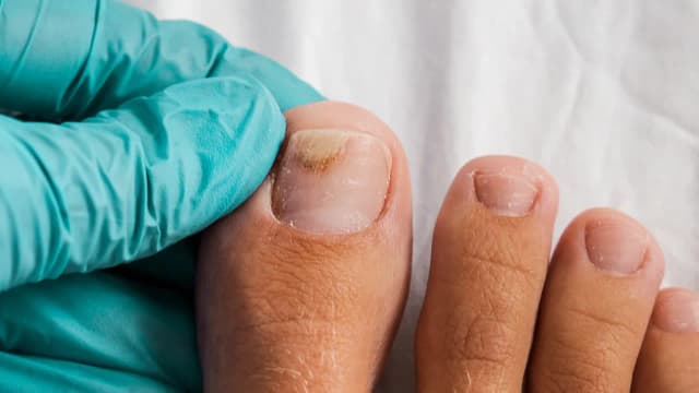 Jak leczyć zrogowaciałe paznokcie u nóg - skuteczne metody i porady