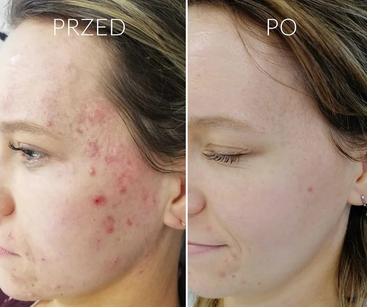 Jak skutecznie pozbyć się pryszcza z ropą i uniknąć blizn