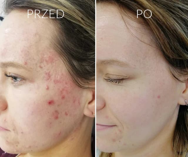 Jak skutecznie pozbyć się pryszcza z ropą i uniknąć blizn