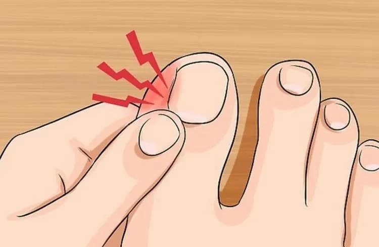 Jak pozbyć się wrastającego paznokcia: skuteczne metody i porady