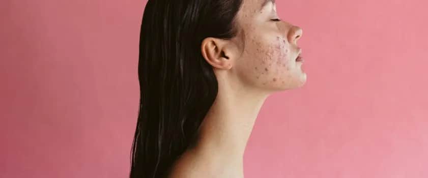 Jak szybko pozbyć się zaczerwienień po pryszczach – skuteczne metody