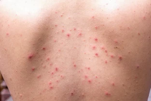 Skuteczne sposoby na pryszcze na plecach – jak się pozbyć problemu