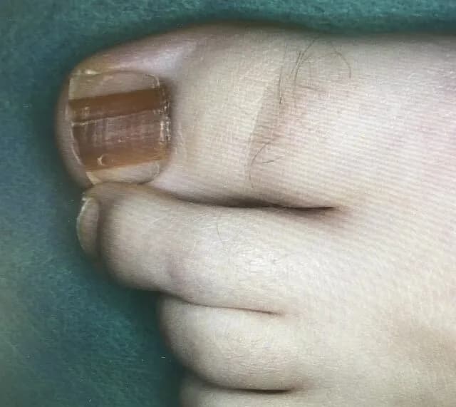 Jak wygląda rak paznokcia? Objawy, które mogą cię zaniepokoić