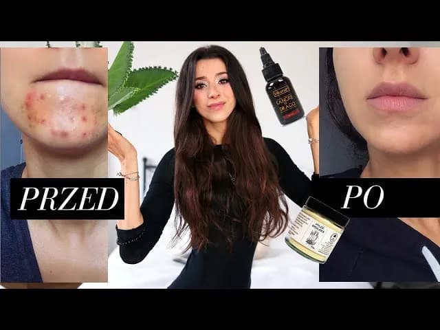 Jak zakryć pryszcza domowym sposobem i uniknąć nieprzyjemnych skutków