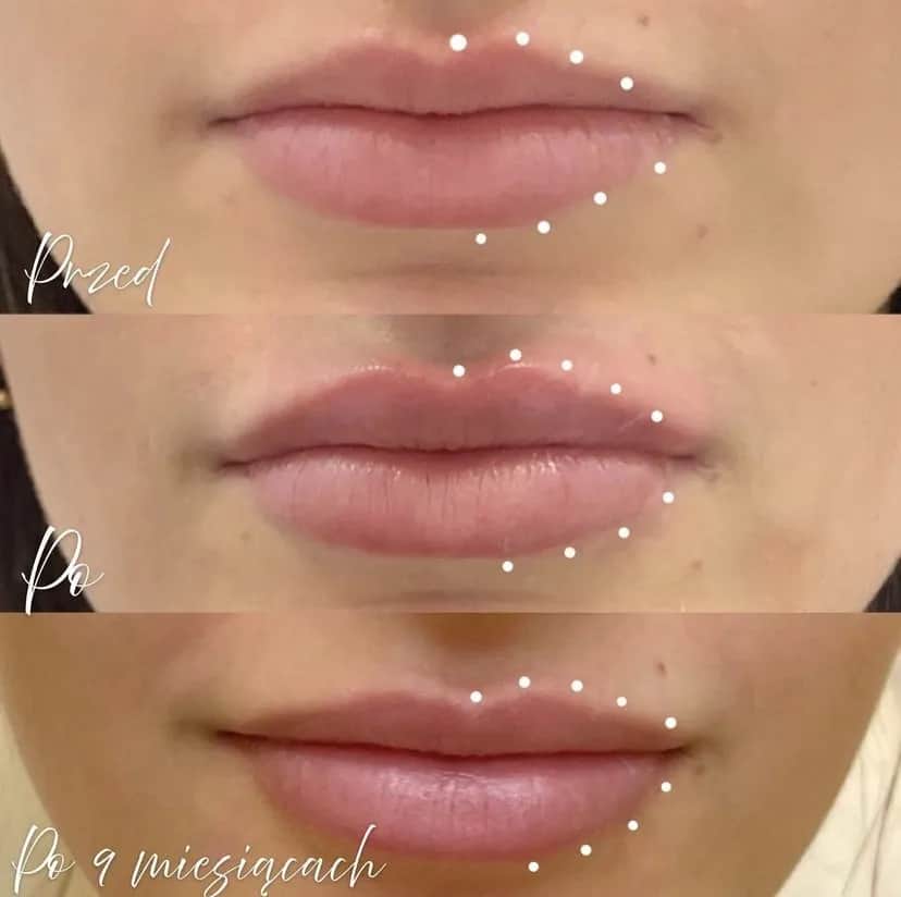 Jak długo się utrzymuje efekt laserowego powiększania ust? Sprawdź!