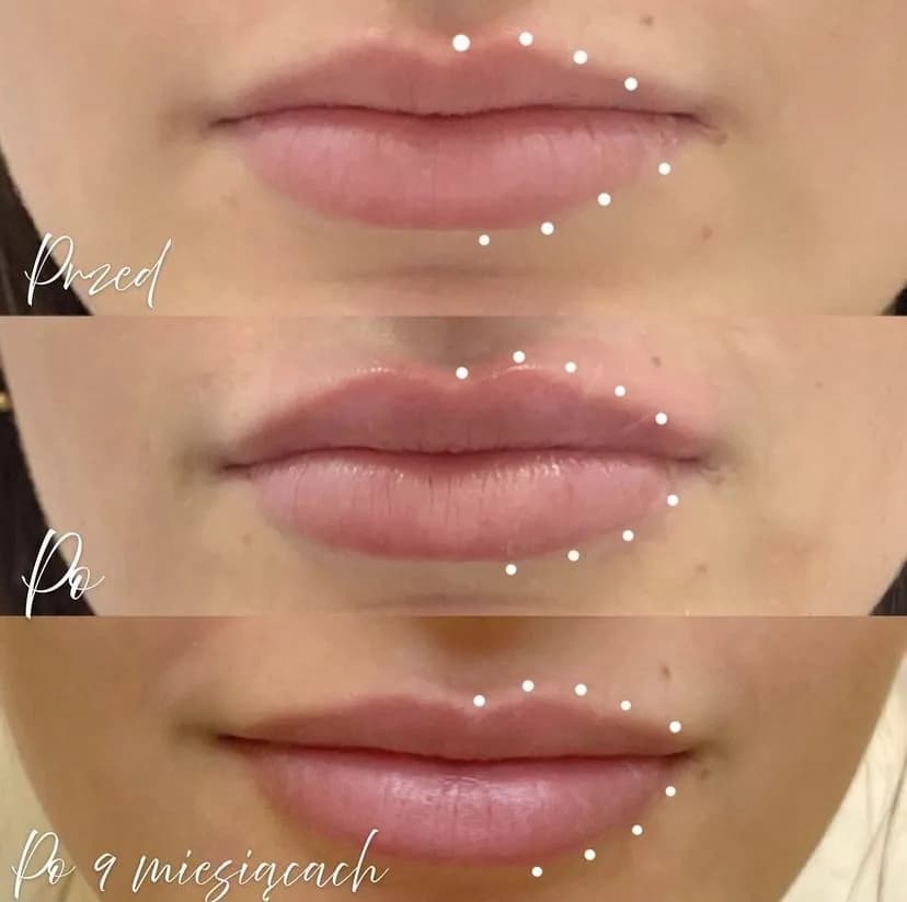 Jak długo się utrzymuje efekt laserowego powiększania ust? Sprawdź!