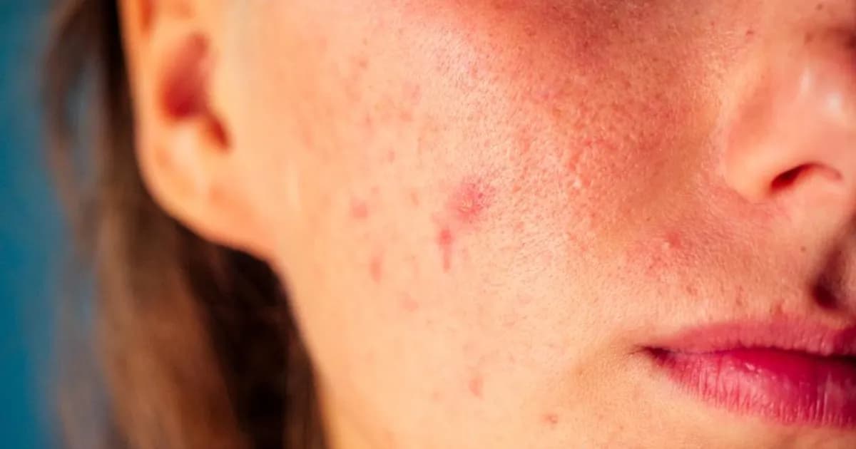 Pryszcz który nie znika: kiedy to może być powód do niepokoju?
