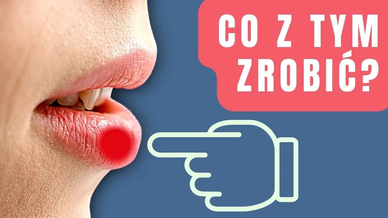 Jak skutecznie pozbyć się pryszcza na ustach i uniknąć infekcji