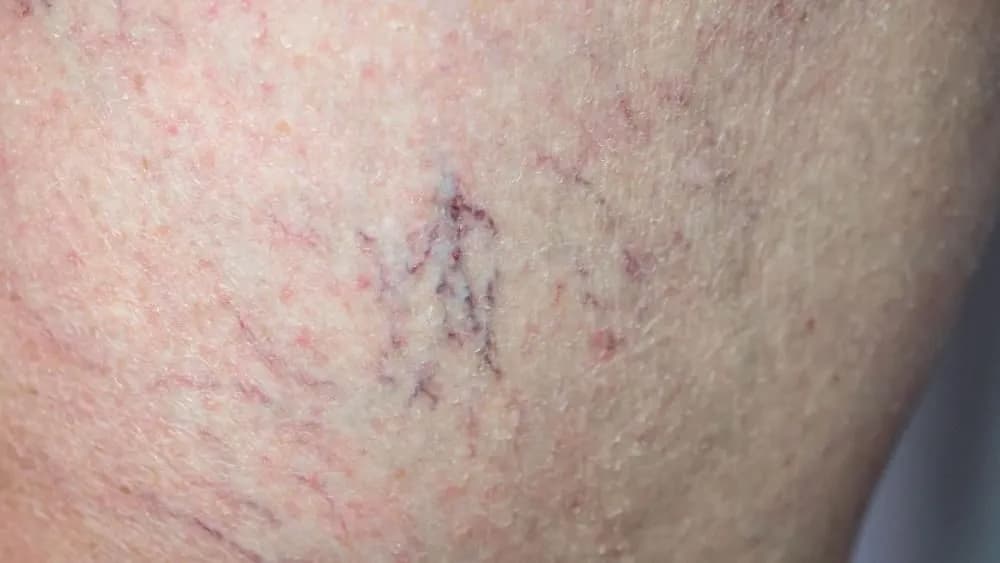 Jak wygląda cera naczynkowa i jak skutecznie ją pielęgnować?