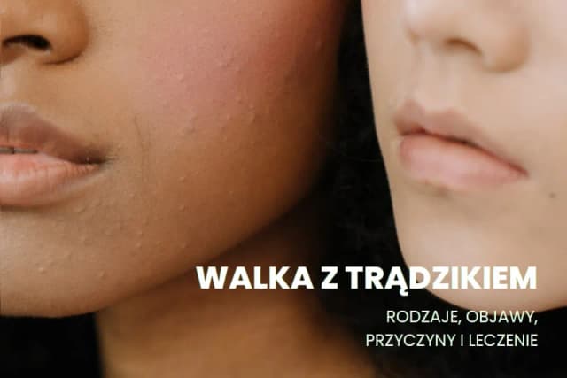 Pryszcze na policzkach od czego - poznaj przyczyny i sposoby leczenia