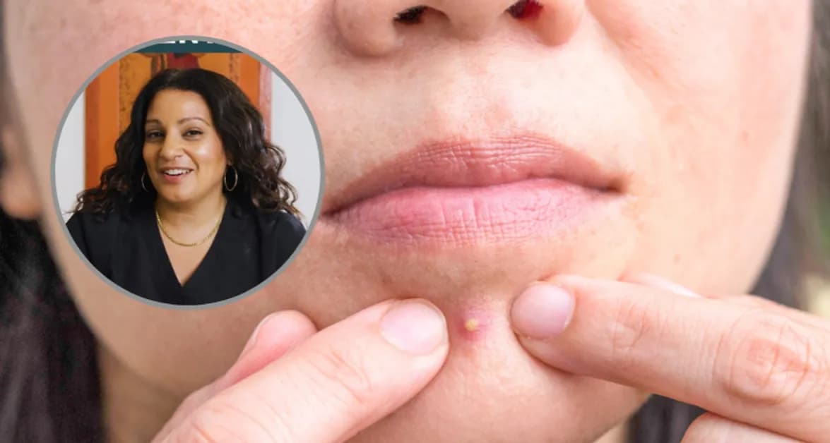 Czy pasta pomaga na pryszcze? Odkryj skutki i lepsze alternatywy