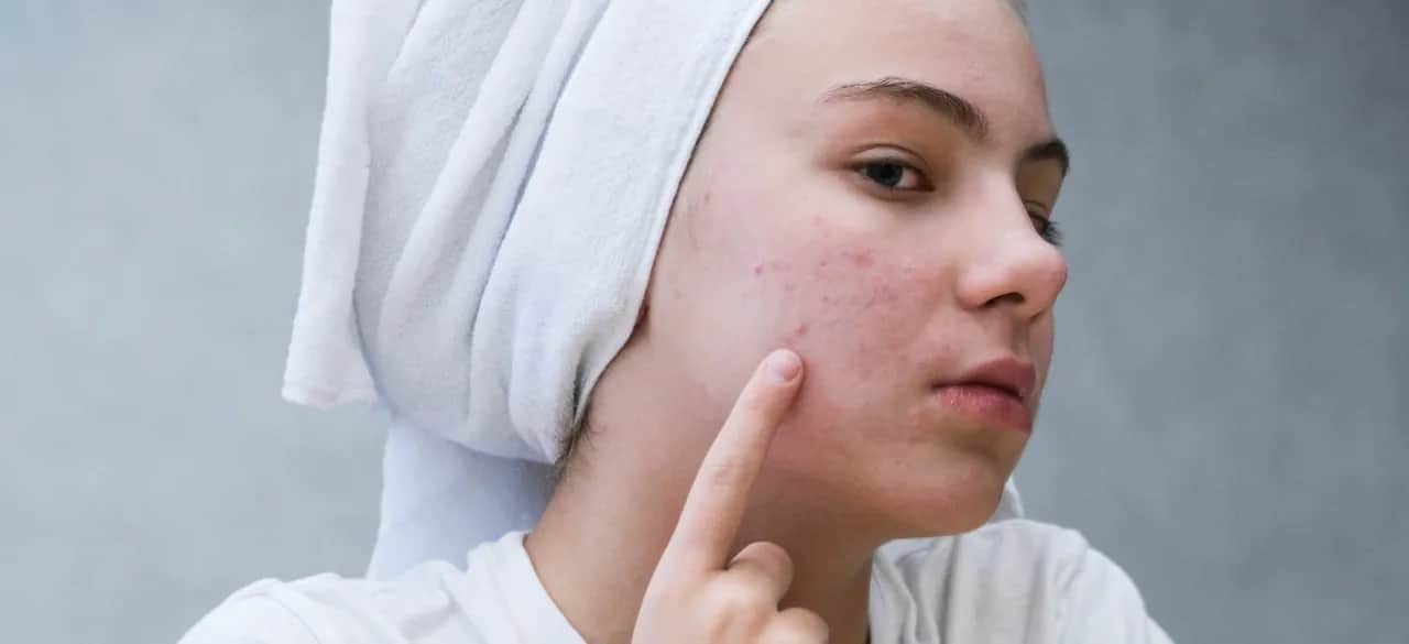 Czy pryszcz sam zniknie? Oto prawda o naturalnym gojeniu