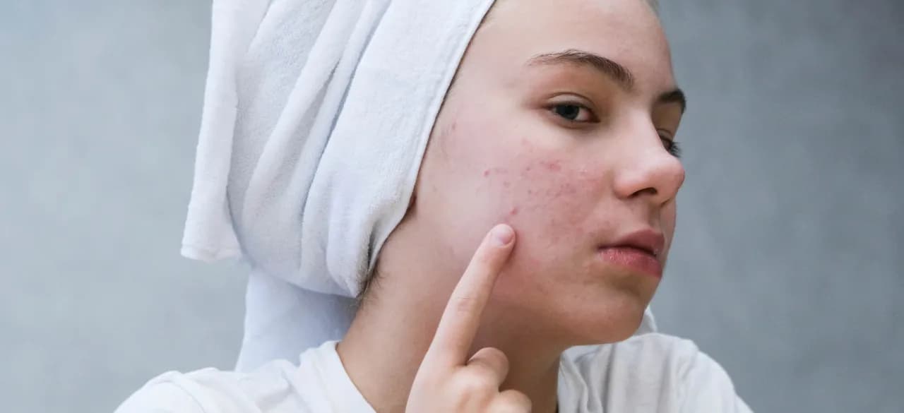 Czy pryszcz sam zniknie? Oto prawda o naturalnym gojeniu