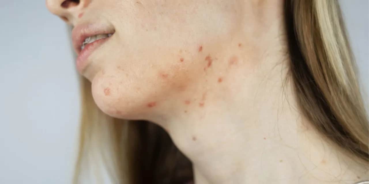 Co oznaczają pryszcze na brodzie? Przyczyny i skuteczne rozwiązania