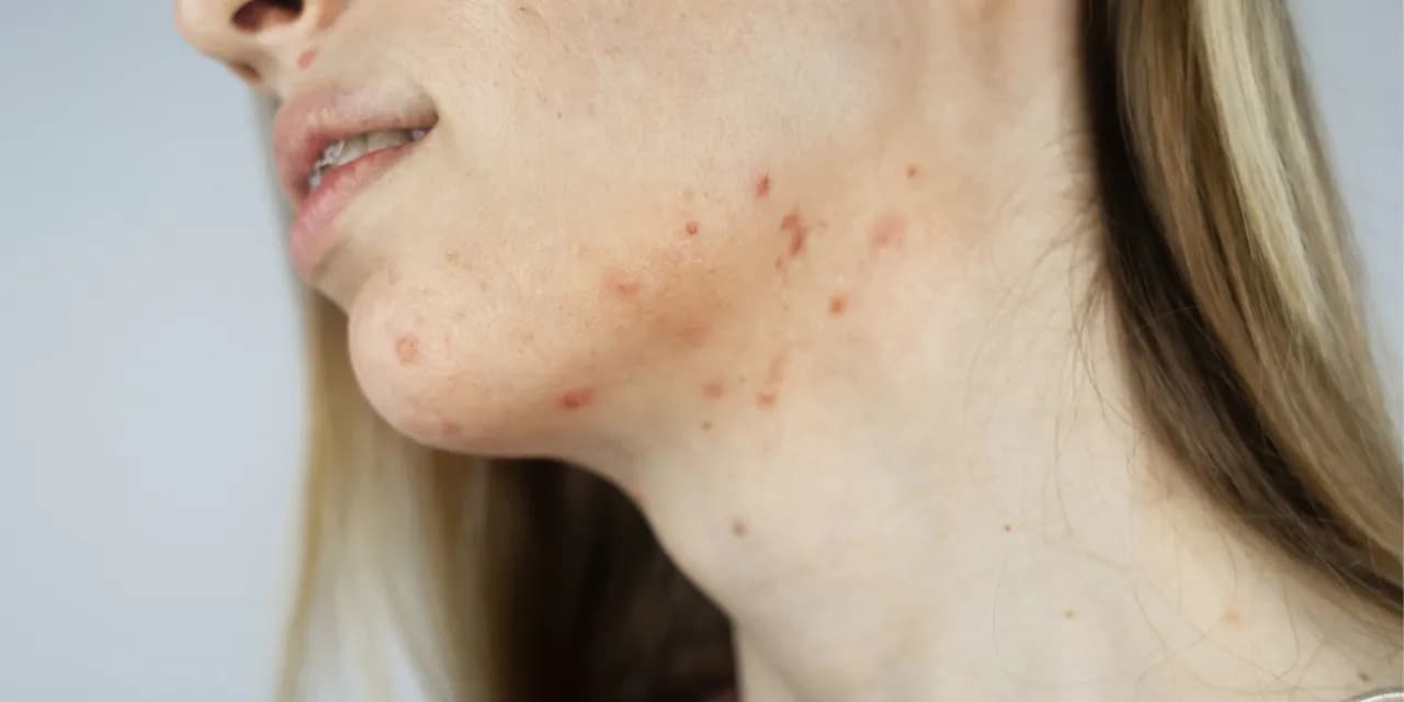 Co oznaczają pryszcze na brodzie? Przyczyny i skuteczne rozwiązania