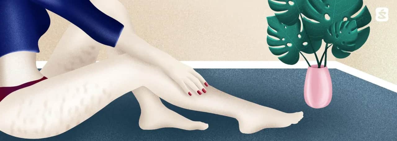 Skuteczne metody na cellulit - jak zredukować jego widoczność