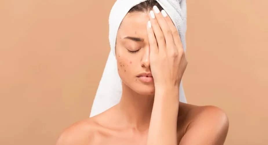 Czy wolno wyciskać pryszcze? Oto skutki, które musisz znać