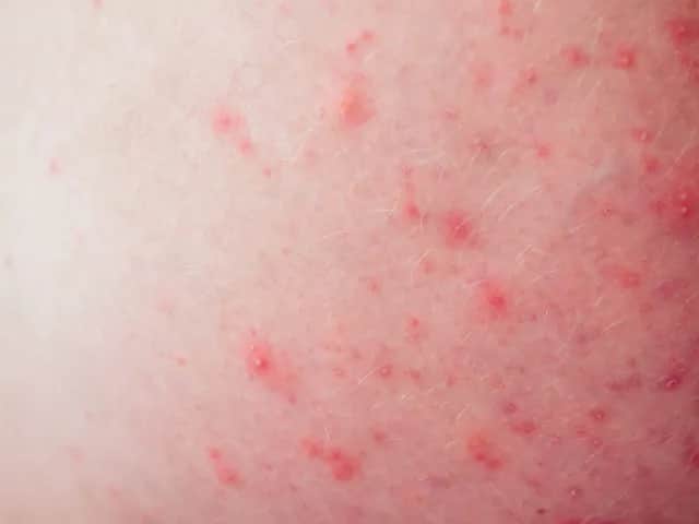 Pryszcze w miejscach intymnych – przyczyny, objawy i co robić?